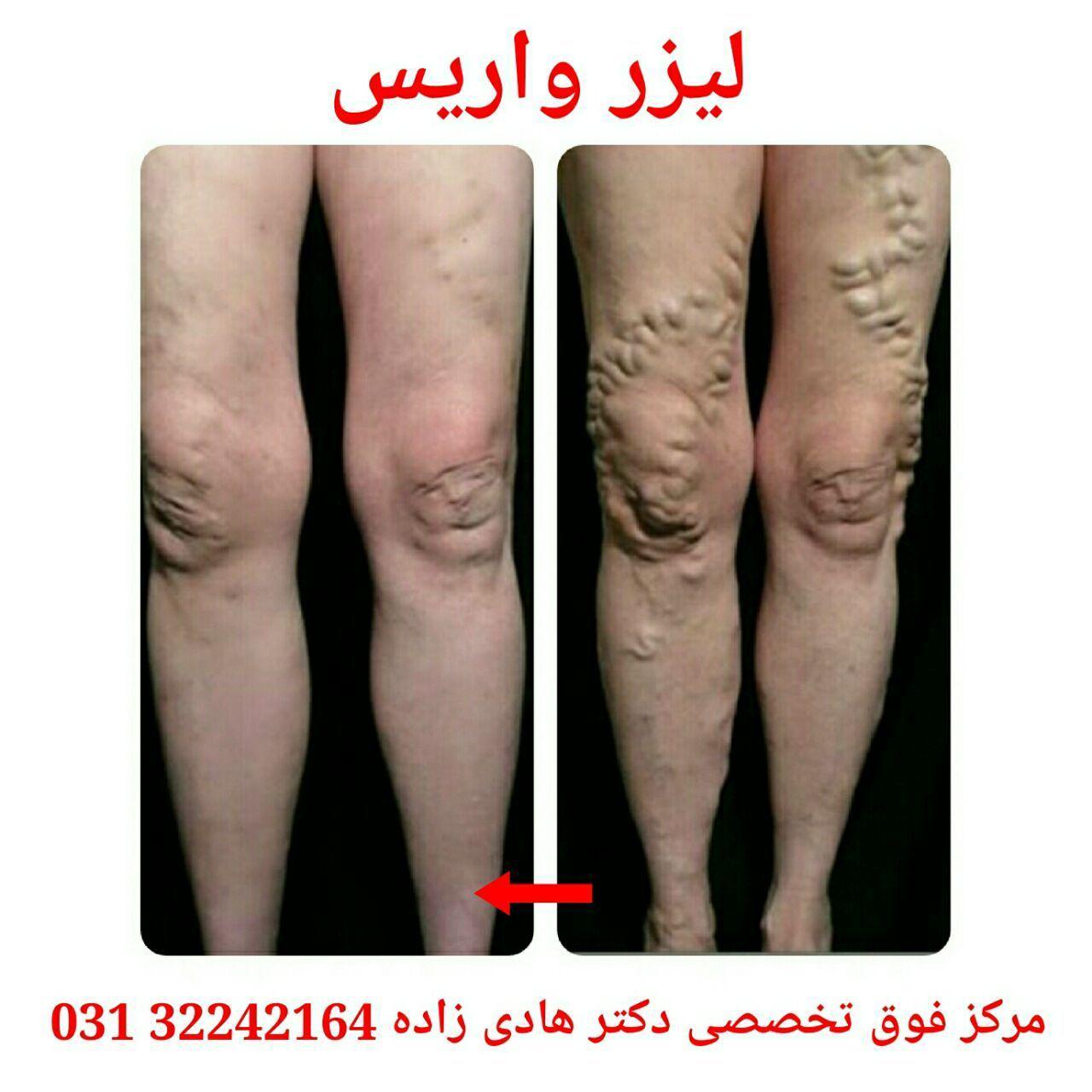 واریس