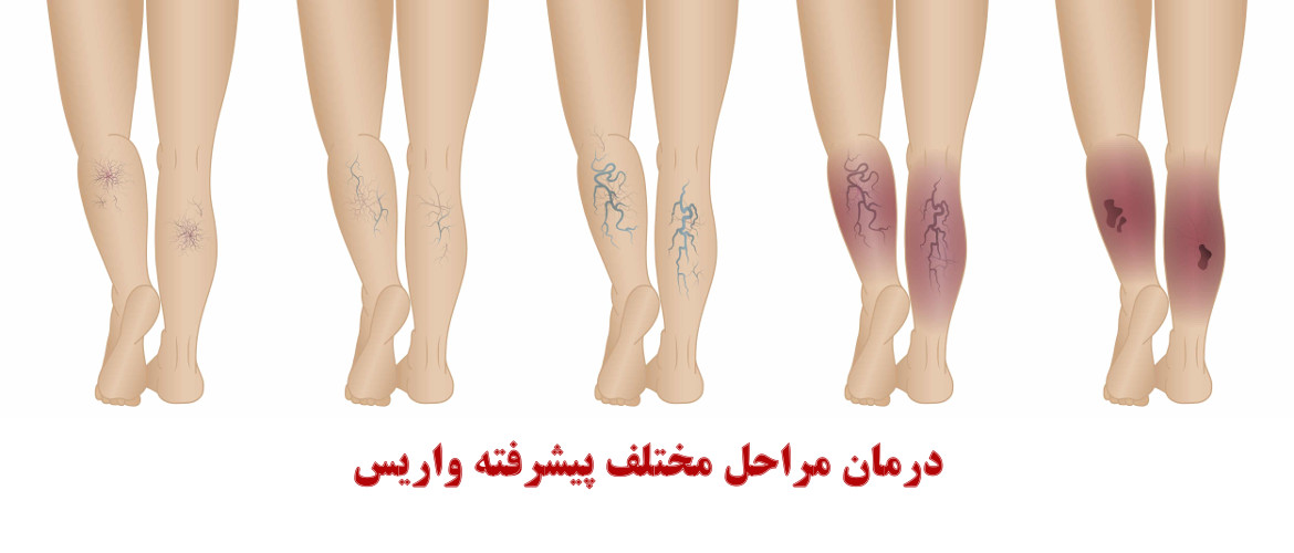 درمان واریس درمان واریس