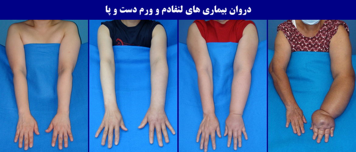 لنف ادم و ورم دست و پا لنف ادم و ورم دست و پا