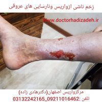 پیشگیری از واریس
